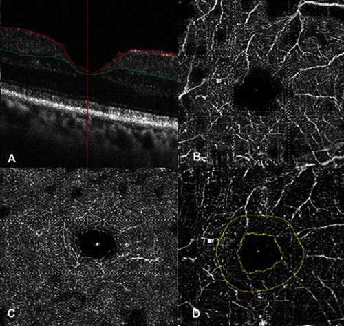 Figure 3 Macular conditions one month after dexamethasone implantation assessed an optical coherence tomography angiography device. (A) Foveal thickness. (B) Superficial vessel density. (C) Deep vessel density. (D) Foveal avascular zone.