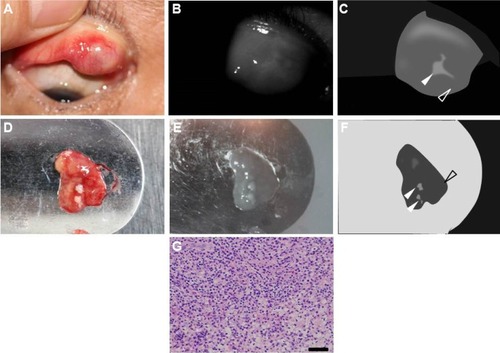 Figure 3 Case 5: a 61-year-old man with chalazion.