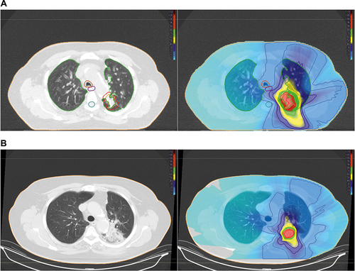 Figure 2 Radiation pneumonitis after SBRT. (A left): 78 years old female patient with histologically proven non-small cell lung carcinoma (within the red contour). Planning target volume (red contour) and organs at risk: Total lung (green), spinal cord (turquoise), oesophagus (violet), trachea (orange). (A right): Treatment plan (VMAT-technology, 5 Gy in 10 fractions, total dose 50.0 Gy): Isodose lines (% of total dose) and the dose distribution, high-dose region surrounding the tumour (red, green), step down gradient (yellow, dark blue), and a large low-dose region highlighted in blue. (B left): Consolidative changes after SBRT, suspect of tumour progression, but radiation pneumonitis was retrospectively diagnosed. (B right): A deformable image registration was used to correlate the lung changes on follow-up CT-scan with radiation dose distribution. The changes are conformal to the high-dose region.