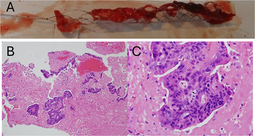 Figure 3 (A) Photograph showing a reddish brown gelatinous thrombus extracted by the stent-retriever. Panels B and C. Photomicrographs of the retrieved thrombi, Hematoxylin and eosin stain, x 100 (B) and x 400 (C), showing fibrin and blood admixed with metastatic adenocarcinoma, which is composed of tubular or fused glands, with pseudostratified epithelium, consistent with colorectal origin. Immunohistochemical stains showed CK7-negative, CD20-positive, and CDX-2-positive.