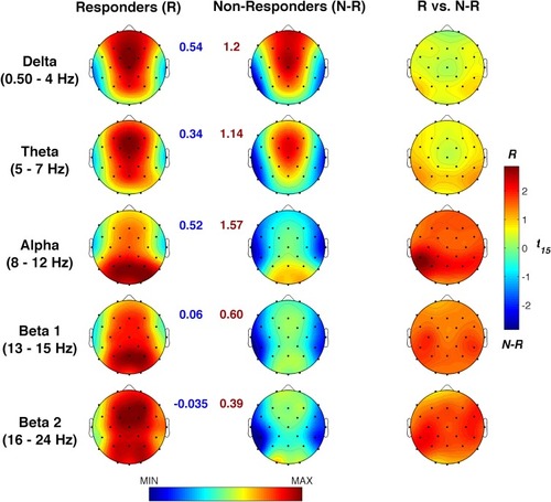 Figure 7 Baseline EEG differences during resting wake between responders and non-responders. Baseline topographic distribution of the waking EEG spectral powers in responders and non-responders and statistical maps of their comparisons by un-paired t-tests. Maps are plotted for the following frequency bands: slow-wave activity (SWA, 0.50–4.75 Hz), theta (5.00–7.75 Hz), alpha (8.00–11.75 Hz), sigma (12.00–15.75 Hz), and beta (16.00–24.75 Hz). Values are colour coded and plotted at the corresponding position on the planar projection of the scalp surface and are interpolated (biharmonic spline) between electrodes. The topographic maps (first and second columns) are scaled between minimal and maximal values considering the two experimental conditions within each frequency band. The minimum (blue number) and the maximum (red number) for each scale are also reported close to the corresponding maps. The statistical maps are scaled symmetrically according to the absolute maximal t-value across the statistical comparisons in all frequency bands.