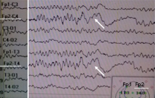 Figure 2 The electroencephalogram of the patient showing slow-waves characterized by strong peaks of delta (δ) and theta (θ) frequencies in the right frontal lobe.