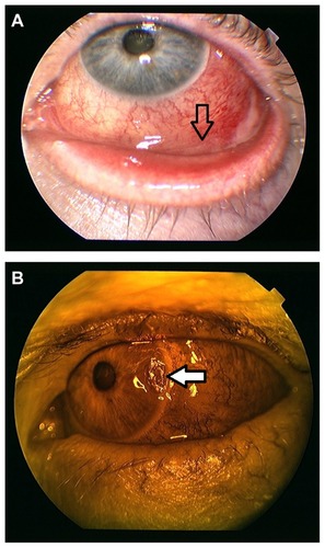 Figure 1 (A and B) Anterior segment slit-lamp photograph of the left eye showing a pink-yellow colored mass infiltrating the bulbar conjunctiva in the lower fornix of the eyelid (arrow) and a corneal ulcer at the 9 o’clock position with perilimbal congestion and chemosis (arrow).