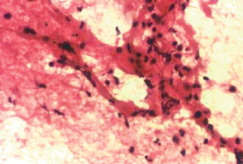 Frozen section from sample taken intraoperatively showing more than 5 polymorphonuclear leukocytes per high-power field (hematoxilyn-phloxine and toluidine blue. 400×).