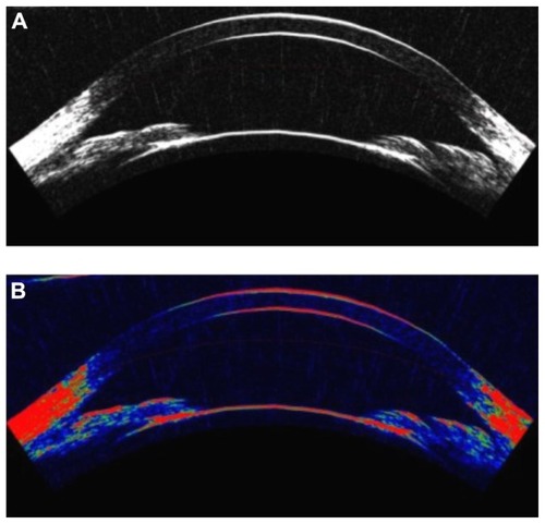 Figure 1 The image was obtained for one of the subjects with Artemis-2 VHFUS for ACA and ACD. A black and white, and B in color.