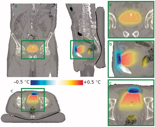 Figure 2. Effect of the presence of an air pocket on the steady state temperature distribution in a typical patient (patient #6) compared to the situation without air pocket. Since the air pocket acts as a thermally insulating layer, the liquid inside the bladder loses less heat to the upper part of the bladder wall. This leads to a higher temperature in the bladder contents, a slightly higher temperature in the upper part of the bladder wall, still in contact with the liquid bladder contents, and a lower temperature in the part of the bladder wall in immediate contact with the air pocket. Shown are (a) a coronal view, (b) a sagittal view and (c) a transversal view through the bladder’s center of gravity. The right-hand column shows zoomed in versions of the bladder region. Gravity points into the paper, to the left, and to the bottom, respectively.