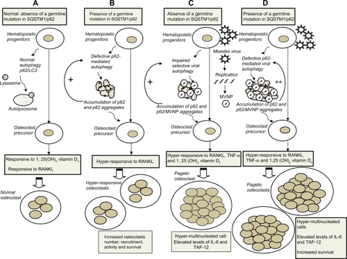 Figure 2 Pathogenesis of Paget’s disease of bone: Viral and genetic interactions, unifying hypothesis. Schematic models of cytoplasmic autophagy in A) normal hematopoietic progenitors with adequate clearance of the autolysosome by the proteasome, B) hematopoietic progenitors carrying a germline SQSTM1/p62 mutation leading to defective p62-mediated autophagy, accumulation of p62, further amplifying the process, and p62 aggregates, C) hematopoietic progenitors with persistent measles virus infection and replication leading to impaired autophagy with accumulation of MVNP/p62 aggregates, D) persistent measles virus infection of hematopoietic progenitors carrying a germline SQSTM1/p62 mutation further amplifies the genetically-induced defective p62-mediated autophagy. B–D) These abnormalities in the autophagy process are perpetuated in cells differentiated from the hematopoietic cells with specific functional consequences on mature osteoclasts (see text).