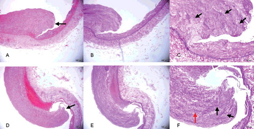 Figure 3. (A, D) Area of intimal layer rupture in the right common iliac artery (black arrow) showing hyperplasia of the intimal layer and depletion of smooth muscle cells, which are replaced with maloriented fibrous tissue (HE×4). (B, E) Area of intimal layer rupture in the right common iliac artery showing hyperplasia of the intimal layer, discontinuity of the internal elastic lamina, only scant rarefaction and fragmentation of elastic fibres and depletion of smooth muscle cells, which are replaced with maloriented elastic fibres and fibrous tissue (EvG×4). (C, F) Higher-power view of the right common iliac artery seen in (B, E) better illustrating the fibromuscular proliferation (red arrow), with rarefaction and fragmentation of elastic fibres (black arrow) in the muscularis and thinned areas of the vessel wall (EvG×10).