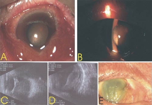 Figure 1 A) Right eye on presentation. The conjunctiva was congestive, the cornea edematous, and the anterior chamber collapsed. B) Extensive choroidal detachment was evident in close contact with the lens. C) Extensive choroidal detachment revealed by a B-scan image. D) B-scan image two months later. E) Four months later, right eye phthisis bulbi.