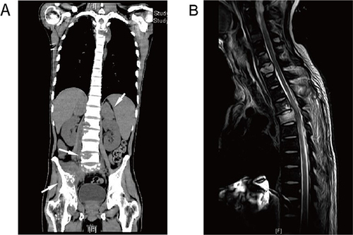 Figure 1 (A) Coronal plane CT scan shows bilaterally enlarged adrenals, and lytic lesions of the right side of T4, L2, L3, and L5 vertebral bodies and pelvic bone. (B) T2-weighted MRI shows high marrow signals in C7 and T4 vertebral bodies. There is some compression of the T4 body and extension into the right pedicle.