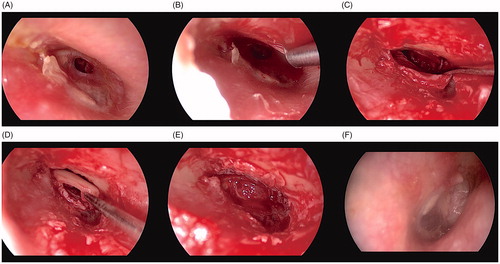 Figure 3. Endoscopic images of patient no: 7, right ear(A) Anterior perforation can be seen (B) Tympanomeatal flap incision on anterior side between 1 to 6 o’clock, (C) Anterior elevation of tympanomeatal flap, (D) Underlay cartilage graft placing, (E) Closure of tympanomeatal flap, (F) Postoperative sixth month control.