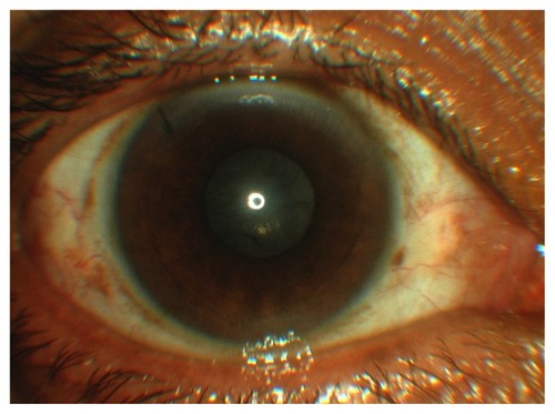Figure 1 Anterior segment photograph showing anterior capsular contraction causing a near total occlusion of the visual axis.
