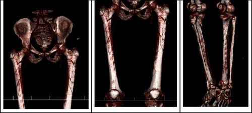 Figure 2 Computed tomography angiography of the patient with diagnosis of Buerger's disease. Occlusion of both superficial femoral arteries with multiple occlusions of left posterior tibial artery without stenosis in the aortoiliac and iliofemoral was observed.