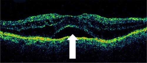 Figure 27 Stratus optical coherence tomography image.