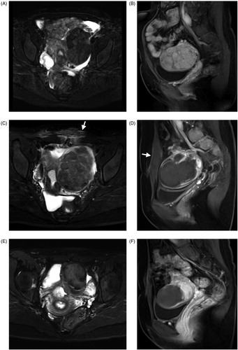Figure 2. A 42-year-old woman with a left broad ligament uterine fibroid and a small submucous fibroid. The fibroid was hypo-intense on T2WI MRI (A) and hypervascular on CE-MRI before treatment (B). There was localized edema and swelling of abdominal muscles (white arrow) (C) and the NPV ratio of the treated fibroid was 91.3% immediately after treatment (D). No abnormal MRI finding related to focused ultrasound ablation was observed (E) and the fibroid volume decreased by 55.5% at 6-month follow-up (F).