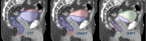 Figure 5. Risk segments of the rectum and bladder according to the competition model. High risk 1–10 Gy (red). Low and moderate risk: from low dose < 1 Gy (green) and from high dose > 10 Gy (blue).