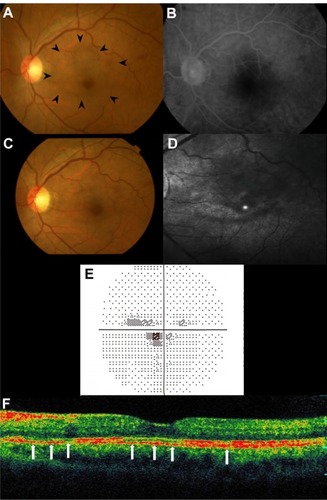 Figure 2 Photographs of the left eye 2 months after the first visit (A and B) and 2 weeks after corticosteroid pulse therapy (C–F): (A) fundus photograph showing the spontaneous absorption of the retinal hemorrhages, although the area of the macular lesion remained unchanged (arrowheads); (B) on late-phase fluorescein angiography, retinal phlebitis and the leakages from the optic disc resolved; (C) the dark reddish lesion improved; (D) the dark area on scanning laser ophthalmoscopy at the lesion site was reduced; (E) on perimetry, the central scotoma had shrunk (mean deviation value: −3.58dB); (F) on optical coherence tomography, the discontinuity of the photoreceptor inner/outer segment junction (arrows) had improved at the fovea.