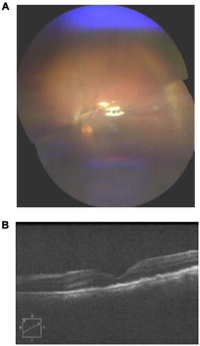 Figure 5 (A) Post-operative follow-up showed good optic disc appearance with pink rim, distinct edge and CDR od 0.2. (B) Anatomical attachment of the retina was achieved.