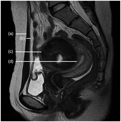 Figure 1. Sagittal view of MRI from a patient with uterine fibroid. (a) Thickness of the subcutaneous fat layer. (b) Thickness of the rectus abdominis. (c) Distance from the anterior surface of the fibroid to the skin. (d) Distance from the posterior surface of the fibroid to the skin.
