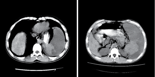 FIGURE 3. Computed tomography (CT) of the abdomen after embolization. The low-density region represents the infarcted area of the spleen.
