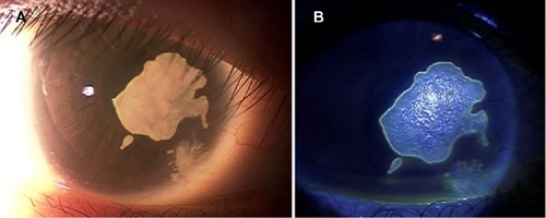 Figure 2 Findings 7 weeks after plastic surgery of the right eyelid (6 months after first visit).