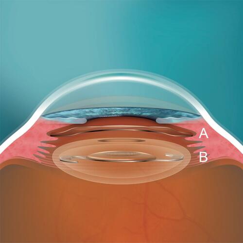 Figure 2 (A) VTICL positioned in the ciliary sulcus as a piggy-back lens. (B) mIOL positioned in the capsular bag which has a circular anterior capsulorhexis.Abbreviations: mIOL, multifocal intraocular lens; VTICL, Visian Toric Implantable Collamer Lens®.