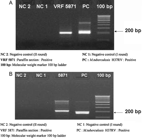 FIGURE 4  (A) Agarose gel electrophoretogram representing the detection of M. tuberculosis genome by polymerase chain reaction targeting the IS6110 region. (B) Agarose gel electrophoretogram representing the detection of M. tuberculosis genome by polymerase chain reaction targeting the MPB64 gene.
