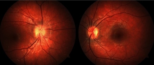 Figure 1 Fundus photos showing pseudo-edema of the right optic nerve due to an astrocytic hamartoma on the surface of the nerve. Optic nerve function was normal and there was no evidence of high intracranial pressure.