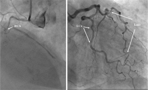 Figure 3 Coronary angiogram from the patient with inferior subendocardial infarction. There is evidence of multivessel disease. The images depicts occluded (arrow) right coronary artery (RCA) (left panel) and multiple significant stenosis (>50 % of reference lumen diameter) (arrows) in left anterior descending artery (LAD) and left circumflex artery (LCx) (right panel).