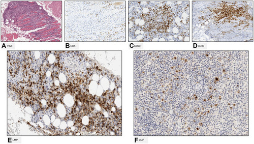 Figure 2 Case 1. Bone marrow (BM) biopsy at progression showing morphological (hematoxylin and eosin, H&E) lymphoid cells (A); original magnification ×20) negative for CD5 (B); original magnification ×20) and positive for CD20 (C); original magnification ×20), CD30 (D); original magnification ×20). Immunohistochemical positivity for EBV (by using Monoclonal Mouse Anti-Epstein-Barr Virus, LMP) of diffuse large B-cell lymphoma in lymph node biopsy ((E); original magnification ×20) and BM aspirate ((F); original magnification ×10).