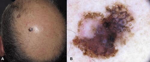 Figure 4 Nevus associated melanoma arising on the scalp in a 60-year old man with androgenic alopecia. (A) Clinically, a asymmetrically pigmented macule is visible surrounding a skin colored papule. (B) In dermoscopy, two components are visible, one flat with atypical pseudo network and obliteration of hair follicles, grey circles, black and brown dots. The pinkish area represents remnants of a dermal nevus.