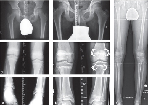 Figure 2. 13-year-old boy with an idiopathic leg-length discrepancy (LLD). A. radiographs centered on the hips, knees, and ankles with LLD of 4.5 cm (right). B. LLD corrrection to 0.1 cm 40 months after femoral and tibial epiphyseodesis. C. Long-standing anteroposterior radiographs at time of follow-up.