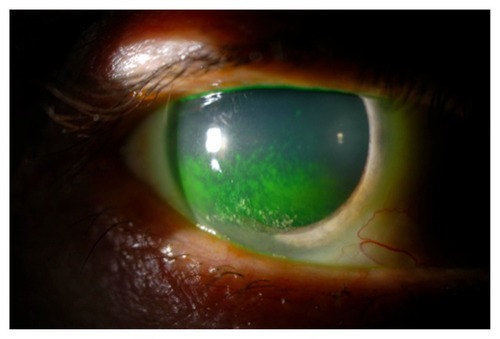 Figure 1 keratoconjunctivitis sicca in a patient with primary Sjögren’s syndrome.