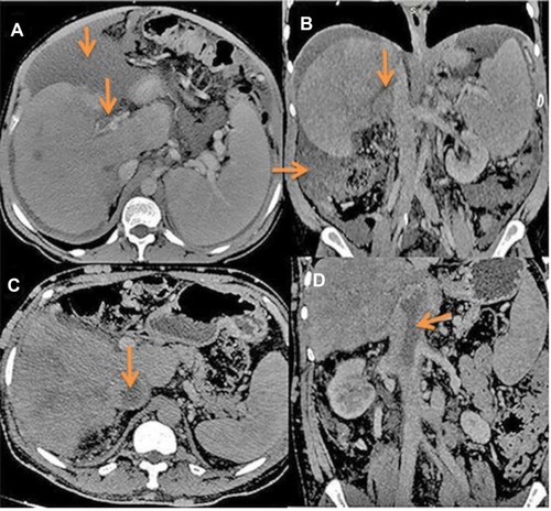 Figure 1 CT findings in BCS: (A) Axial CT image in a patient with acute BCS shows thrombosis of main portal vein seen as filling defect (arrow, A). Coronal CT image in another patient with acute BCS: shows filling defect in the middle HV (arrow, B). Ascites is also seen. Axial and coronal CT images in a patient with thrombosis of IVC seen as filling defect causing expansion of the lumen (arrows, C and D).