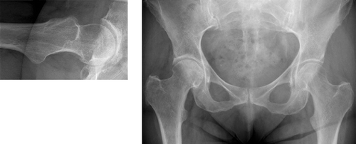 Figure 34. Coxa profunda in a 56 year old female: deep position of acetabulum at the ilio-ischial line requires a round head. Head/neck ratio = 1.5