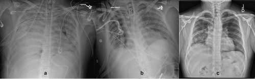 Figure 1. A 27-year-old overweight patient who developed severe COVID-19 needing initiation of venovenous ECMO 18 days after the onset of symptoms. He was initially supported via fem-fem cannulation for 35 days that was transitioned to oxy-RVAD cannula via the internal jugular approach due to impending right ventricular failure. He was evaluated for lung transplantation but declined due to lack of social support. The pulmonary physiology started to improve >60 days on ECMO and he was decannulated after 75 days on ECMO. His serial chest radiographs show progressive improvement as compared to baseline (1A). At 1 year clinic visit after COVID-19, he had a room air 6-min walk although spirometry showed restrictive ventilatory defect. (A) Chest radiograph at 1 month after COVID-19. (B) Chest radiograph at 3 months. (C) Chest radiograph at 6 months.