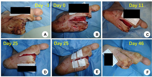 Figure 1 The comparison of one patient in the treatment group before and after treatment. (A) At admission; (B) before enrollment, no obvious necrotic tissue on the wound after debridement; (C) after the second cycle of negative-pressure wound therapy (NPWT); (D) after the fourth cycle of NPWT; (E) the application of the adhesive non-invasive skin stretching device; (F) wound healing.