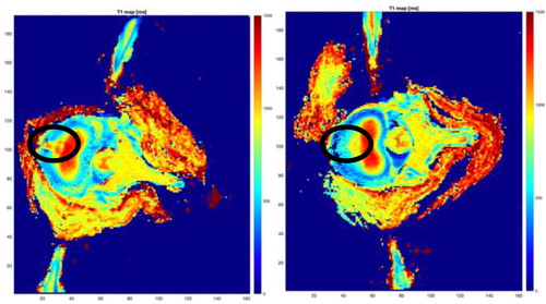 Figure 2. T1 map of the fissured disc positioned in extension (left) and flexion (right).