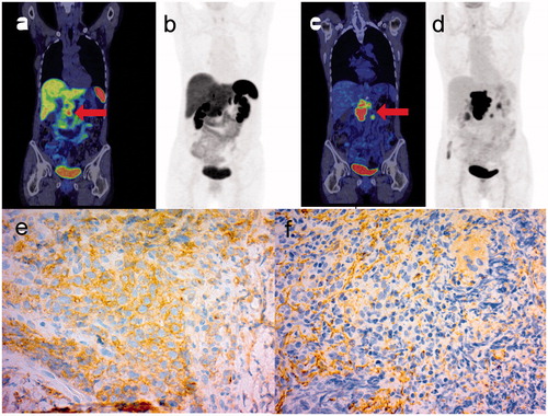 Figure 1. 68Ga-DOTANOC PET/CT (a) and maximum intensity projection (MIP) (b) images with corresponding FDG PET/CT images (c, d) of a patient with DLBCL in the pancreas mimicking NET. The lymphomatous tumor in the head of the pancreas is indicated with an arrowhead. Note that FDG PET/CT was performed six months after the first scan, and progression of lymphoma while the patient was on octreotide treatment is evident. IHC of subtype 2 (e) is positive for the malignant cells, while IHC of subtype 3 (f) shows immunopositivity only in endothelial and connective tissue.