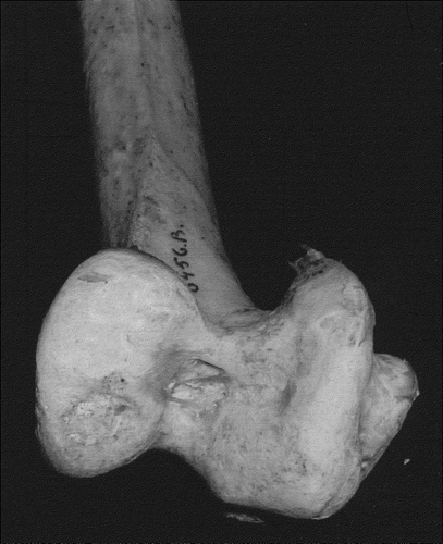 Figure 3. Inferior view of common rhea (Rhea Americana) femoral condyle. Focal articular surface defect from osteochondritis dessicans.