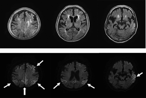 Figure 2. b. Magnetic resonance imaging (MRI) findings obtained using fluid-attenuated inversion-recovery (FLAIR) (upper) and diffusion-weighted images (DWI) (lower) in an 89-year-old woman at 4 months after the initial examination. DWI shows the expansion of the cortical hyperintensity areas in both hemispheres, relative to the previous findings.