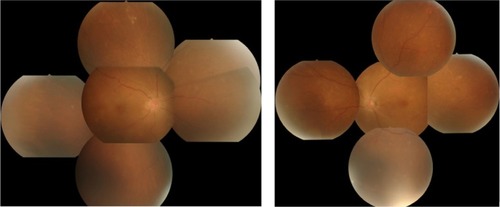 Figure 4 Fundus examination performed 1 week after the start of treatment.