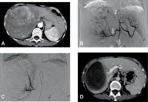 Figure 2 A 69-year-old woman with a huge hepatocellular carcinoma (HCC) who underwent a combination therapy with drug-eluting bead transarterial chemoembolization (DEB-TACE) and hepatic arterial infusion chemotherapy (HAIC). (A) Pretreatment dynamic CT demonstrated a HCC mass of 15.1 cm in diameter in the right lobe; (B) digital-subtraction angiography (DSA) before embolization showed the tumor-feeding vessels derived from right hepatic artery and right phrenic artery (arrows), which were then embolized by DEB and Embosphere® beads; (C) after embolization in the first DEB-TACE procedure, DSA showed that the tumor blush remained but significantly reduced, and then the microcatheter was reserved at the right hepatic artery to perform hepatic arterial infusion chemotherapy; (D) dynamic CT images 31 days after the second procedure of DEB-TACE and HAIC demonstrated shrinkage (12.5 cm in diameter) and complete necrosis of the targeted tumor and the patency of main trunk and first-order branch of portal vein.