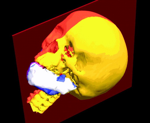 Figure 2. The healthy template is shown semi-transparently in blue. The mandible is shown in white. The midsagittal plane is indicated in red. [Color version available online.]