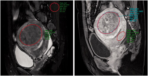 Figure 2. The measurements of MR parameters. A quantitative MR image was analyzed drawing an ROI within area of the fibroid, skeletal muscle, and the myometrium on one of the MR images. The software automatically calculate the quantitative parameters. (A) Signal intensity value of uterine fibroids and skeletal muscle; (B) the contrast-enhance signal intensity value of uterine fibroids and the myometrium.