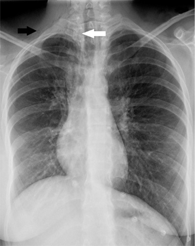 Figure 1 Frontal chest radiograph.