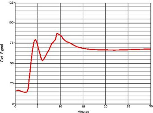Figure 3 Example of hypercoagulopathy (ACT161, CR44, PF4.8). Clot signals grew and had peaks during the testing time of 30 min.