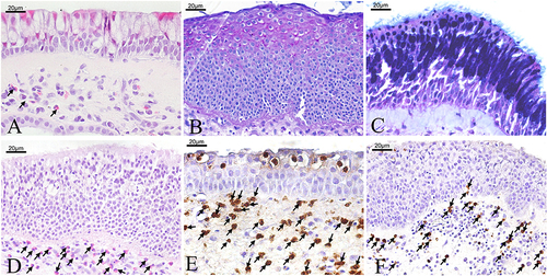 Figure 1 The H&E staining in two groups. The H&E staining in control group (A). The PAS staining and H&E staining in NP group (B–D). Immunohistochemistry staining for neutrophils (E) and macrophages (F) in nasal polyps. Black Arrows indicated inflammatory cells that expressed the corresponding markers. All the pictures were taken under a light microscope at ×400 magnification (Scale bar = 20μm).