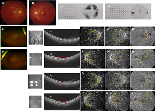 Figure 4 Fundus images of both eyes in case 4. Initial fundus photography revealed white-yellow lesions in the posterior retina in both eyes (Right: (A), Left: (B), photocopy from local records). The 30–2 visual field test showed visual defects on nasal and temporal fields in the right eye (C), while it was normal in the left eye ((D), photocopy from local records). At presentation, fundus photography showed reduced white-yellow lesions (Right: (E), Left: (F)) and OCT scan disclosed hyper-reflective segment of the OPL and ONL in the fovea of both eyes, also with associated disruption of ellipsoid, interdigitation zones, and RPE layers (Right: (G), Left: (H), red box). OCTA showed perfusion defects in the superficial (I and L)/deep (J and M) retinal capillary plexuses, also in the choroidal capillary plexus (K and N) on wide field OCTA in both eyes (Right: (I–K). Left: (L–N), yellow circle). Hyper-reflectivity of the OPL and ONL slightly faded (Right: (O), Left: (P), red box) one week after oral prednisone administration, as observed in OCT. Superficial (Q and T)/deep (R and U) retinal capillary defects, and choroidal (S and V) capillary defects slightly resolved on OCTA (Right: (Q–S). Left: (T–V), yellow circle).