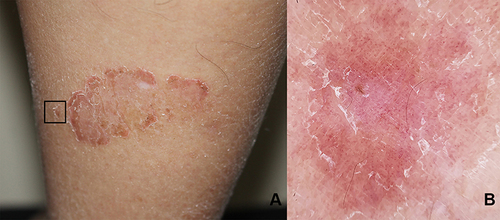 Figure 5 (A) Clinical image of dermatitis, square indicates (B) dermoscopic image showing dull red background, patchy distribution of vessels and scales (x10 original magnification).